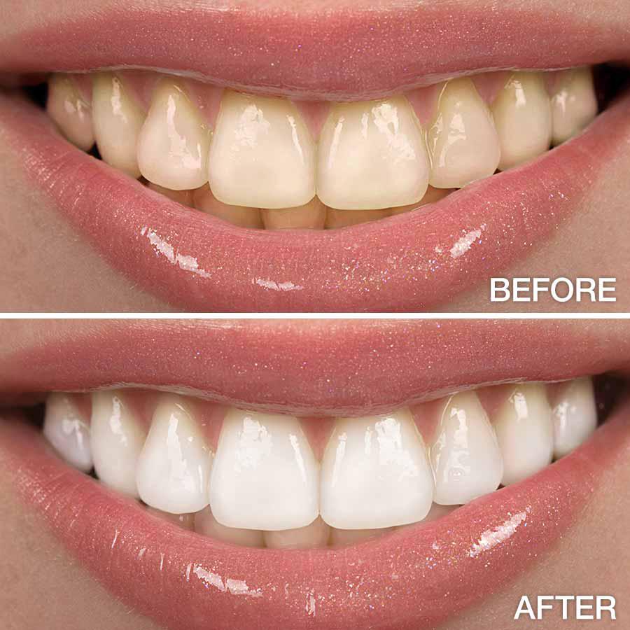 BrightSwipe™ Viral Teeth Whitening Serum Pen + Dual-Peroxide Formula & Xylitol